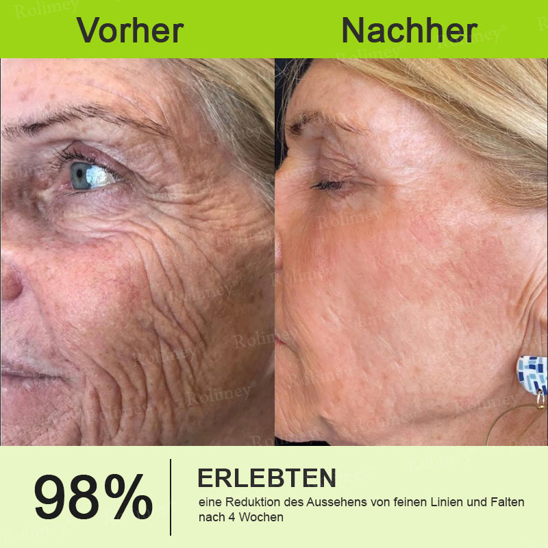 💛🐬Jetzt jugendliche Haut zurückgewinnen 💫Rolimey® Botox & Vita-A Retinol Shot Falten-Lift Straffungscreme