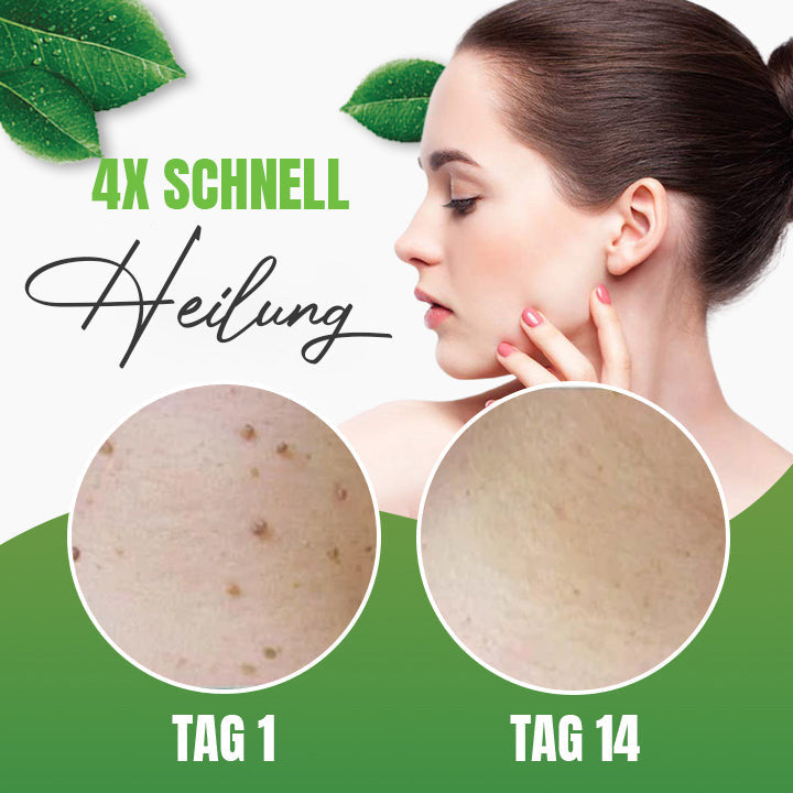 Seurico™ Natürliches Hautwarzen Kräuterentfernungs-Pflaster