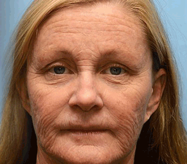 💛🐬Jetzt jugendliche Haut zurückgewinnen 💫Rolimey® Botox & Vita-A Retinol Shot Falten-Lift Straffungscreme