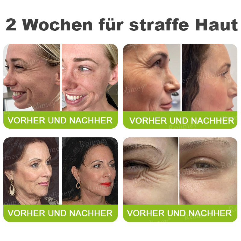 💛🐬Jetzt jugendliche Haut zurückgewinnen 💫Rolimey® Botox & Vita-A Retinol Shot Falten-Lift Straffungscreme
