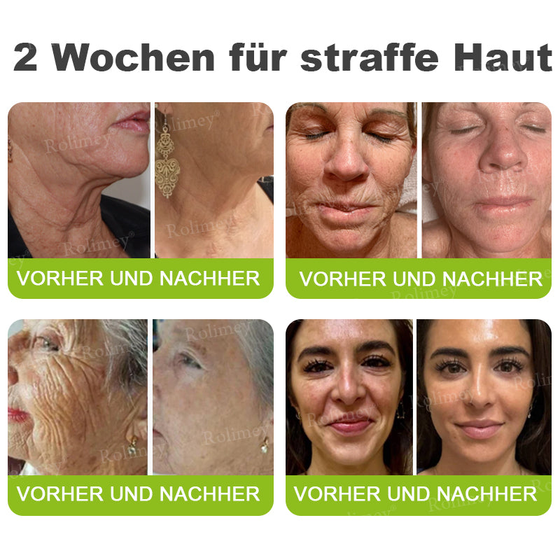 💛🐬Jetzt jugendliche Haut zurückgewinnen 💫Rolimey® Botox & Vita-A Retinol Shot Falten-Lift Straffungscreme