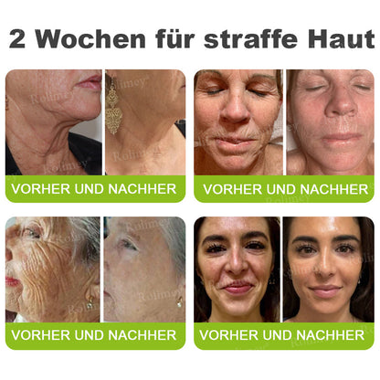 💛🐬Jetzt jugendliche Haut zurückgewinnen 💫Rolimey® Botox & Vita-A Retinol Shot Falten-Lift Straffungscreme